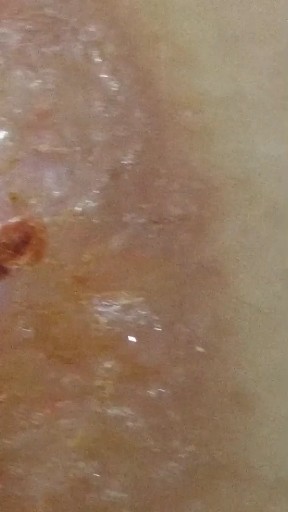 已经结巴脱落的那些地方流水咋了